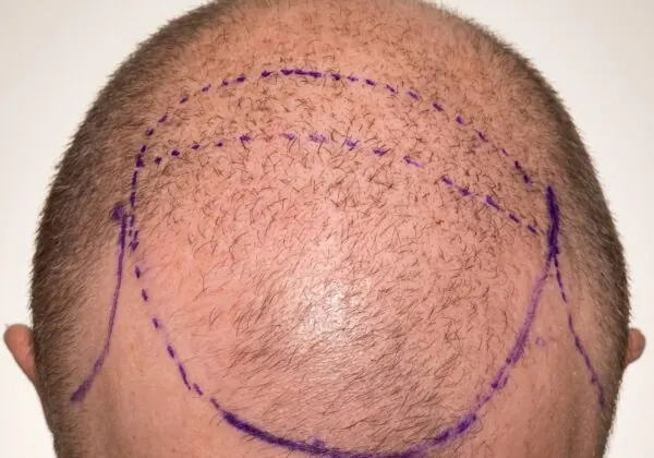 FUE Hair Transplant - before treatment