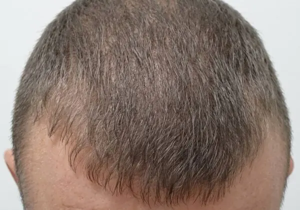 FUE Hair Transplant - after treatment