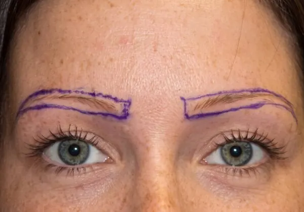 Eyebrow Transplant - before treatment