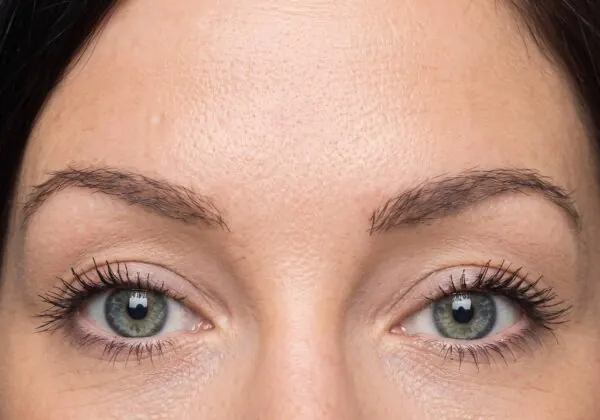 Eyebrow Transplant - after treatment