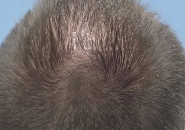 Hair Transplant Repairs - after treatment