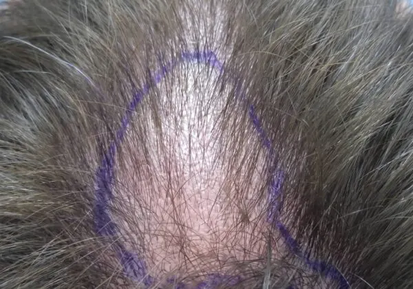Hair Transplant Repairs - before treatment