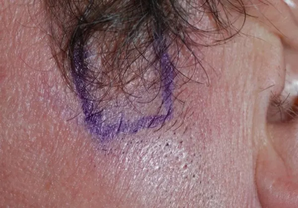 Beard to Scalp - before treatment