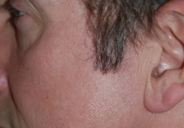 Beard to Scalp - after treatment