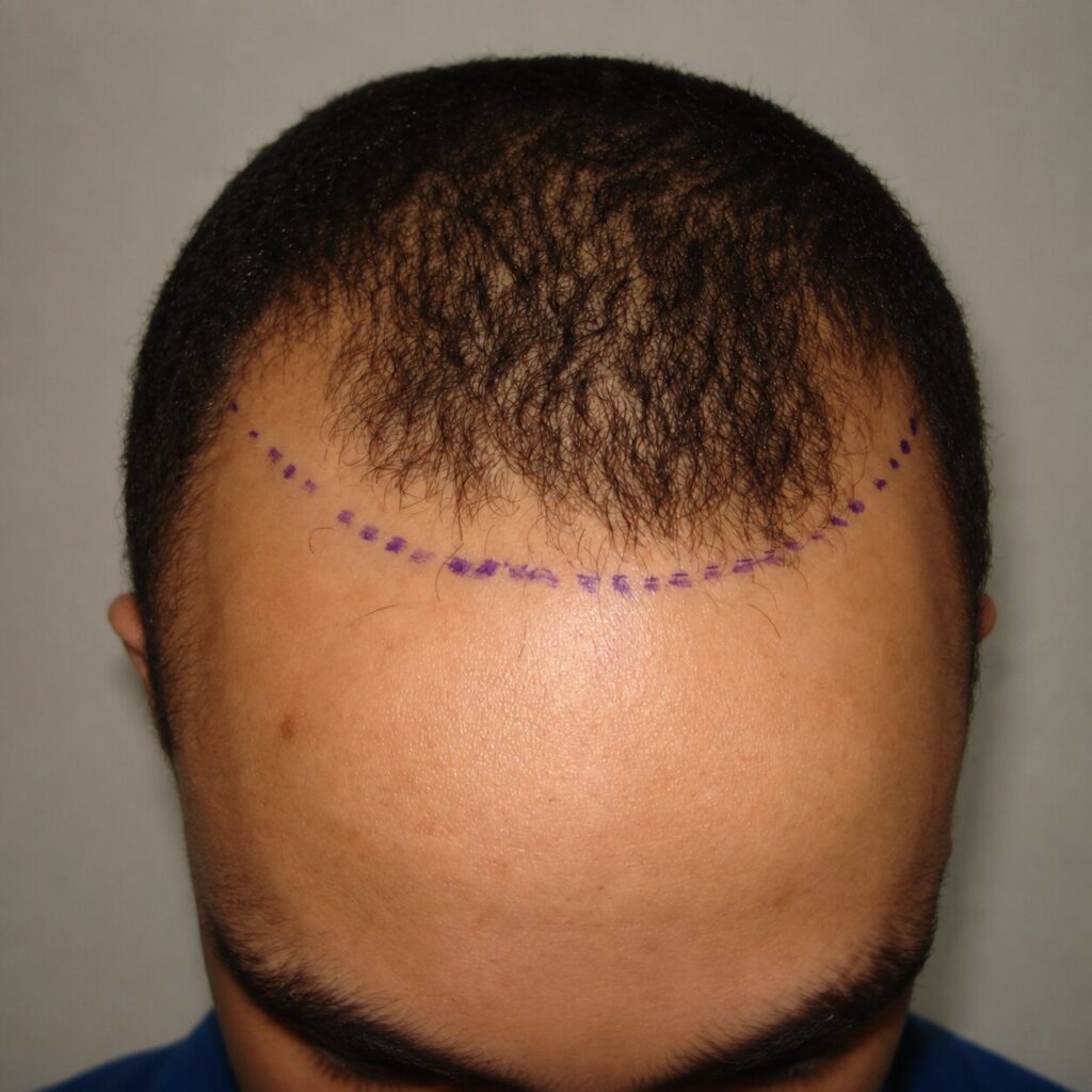 Afro Hair Transplant - before treatment