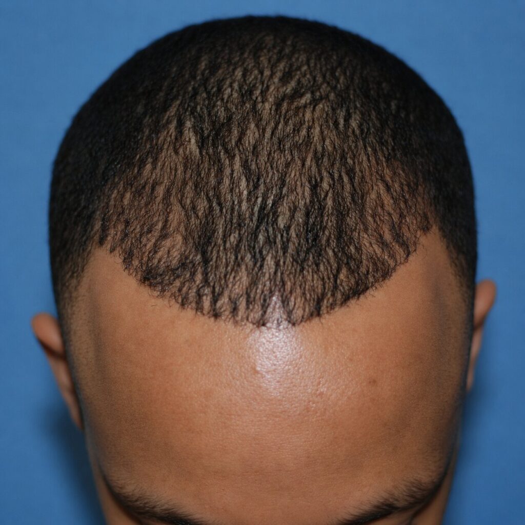 Afro Hair Transplant - after treatment