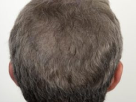 Alan’s Hair Transplant