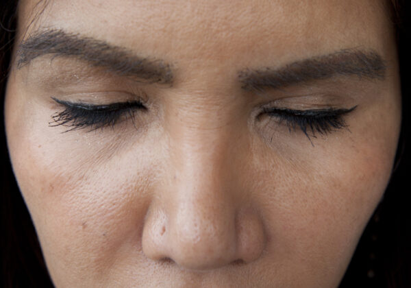 Elizabeth’s Eyelash and Eyebrow Transplant