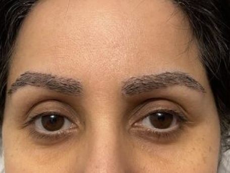 Noor’s Eyebrow Transplant