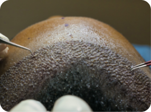 Afro Hair Transplants