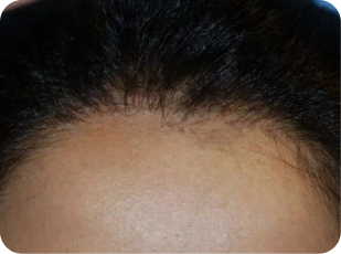 Hair transplants for women