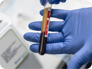 Platelet Rich Plasma