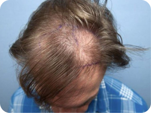 Follicular Unit Transplantation