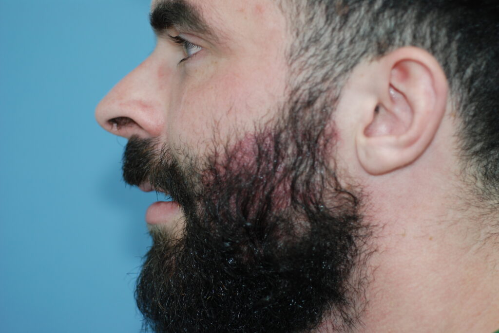 Beard Hair Transplant - after treatment