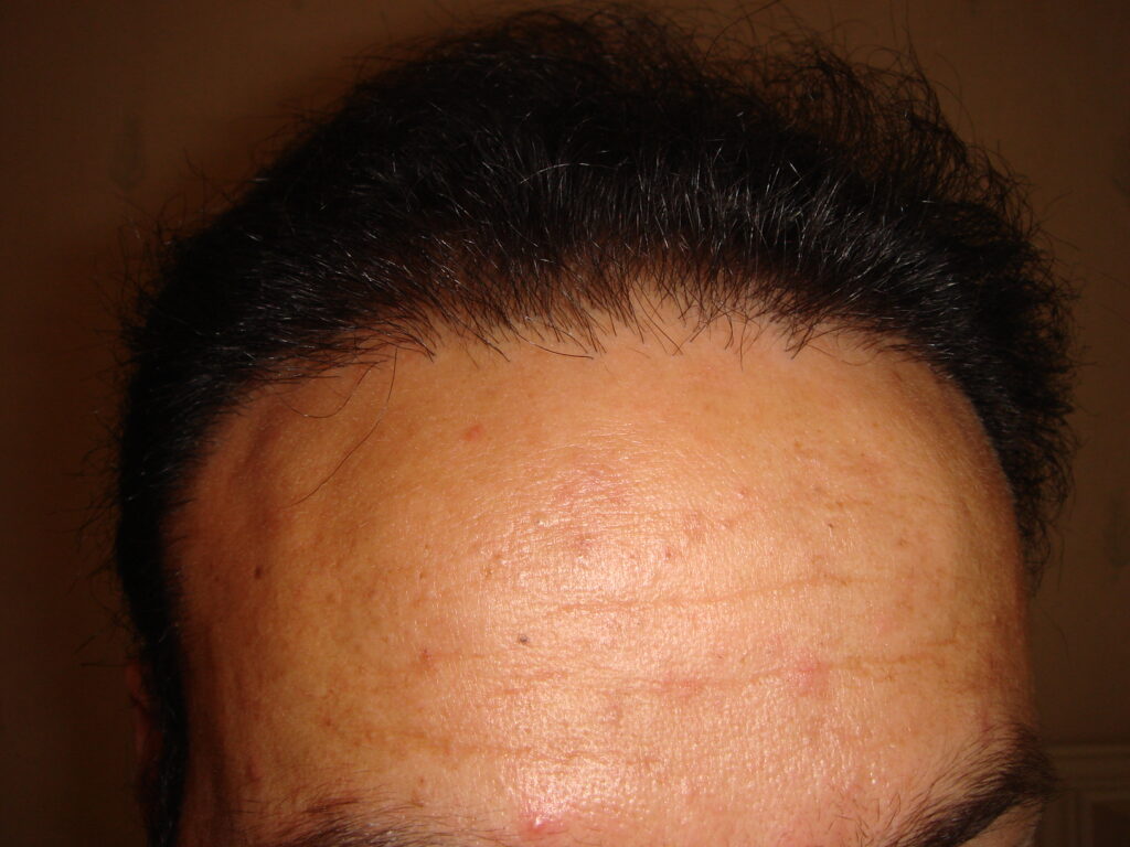 FUT number 3 - after treatment