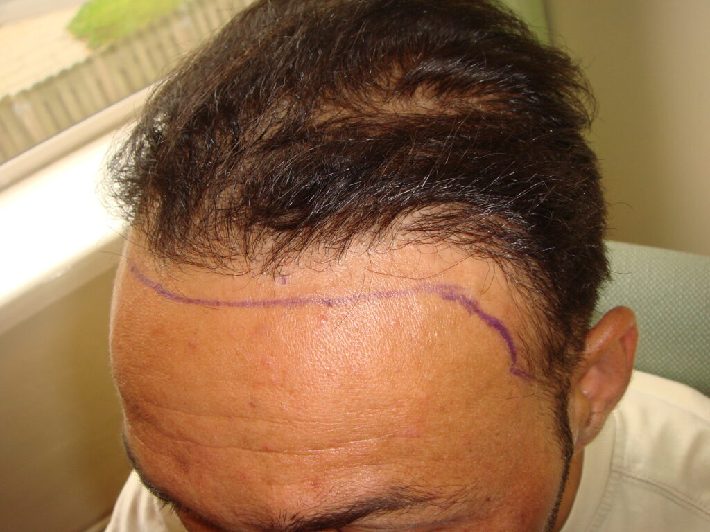 FUT number 3 - before treatment