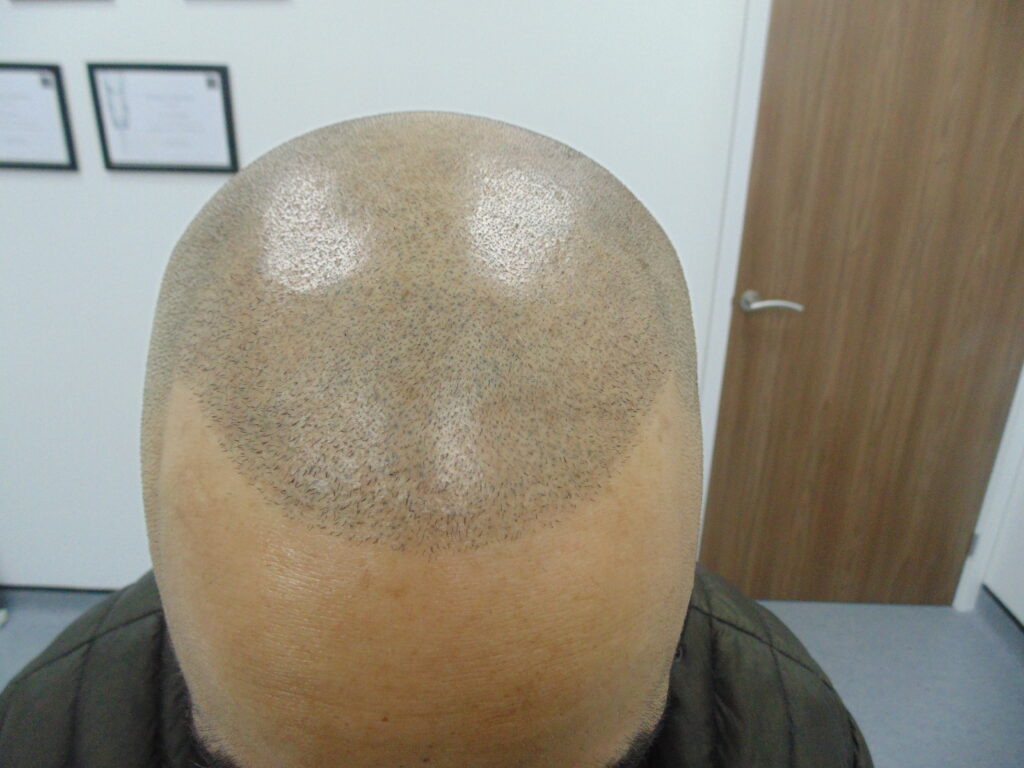 Scalp Micropigmentation 1 - after treatment