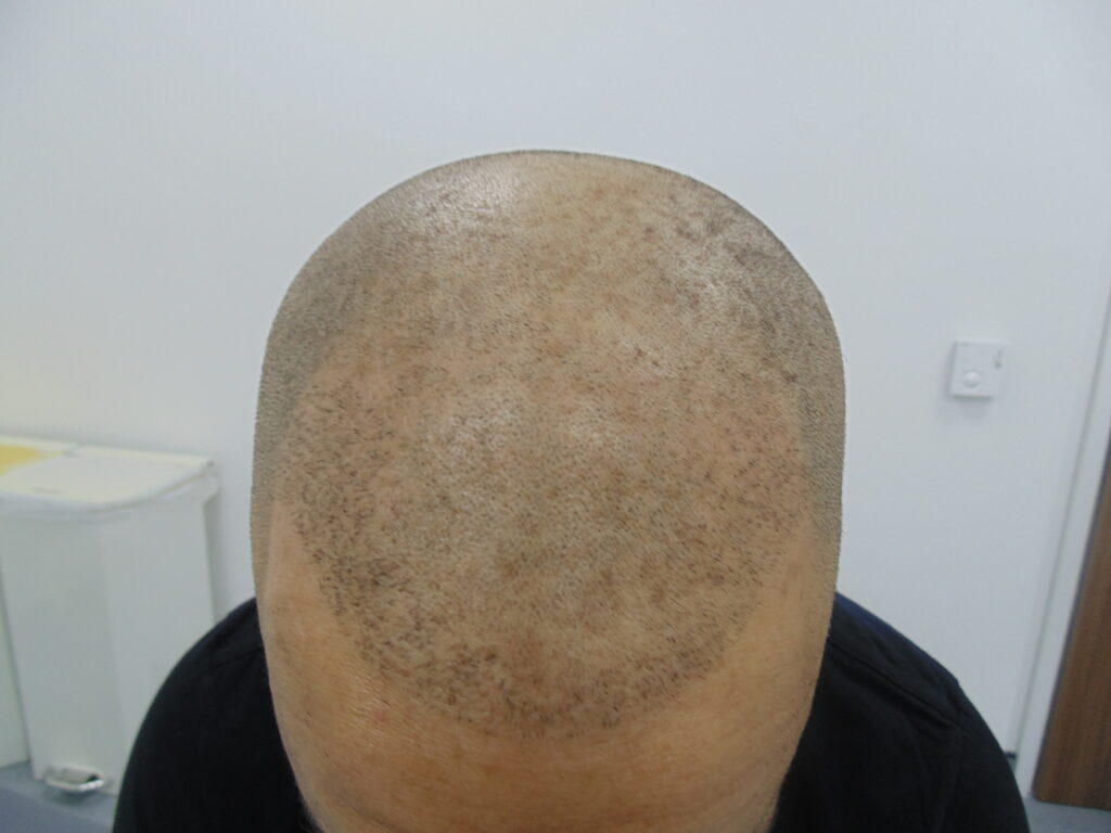 Scalp Micropigmentation 1 - before treatment
