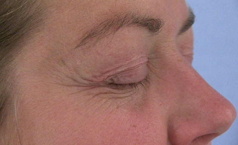 Eyelash 3 - before treatment