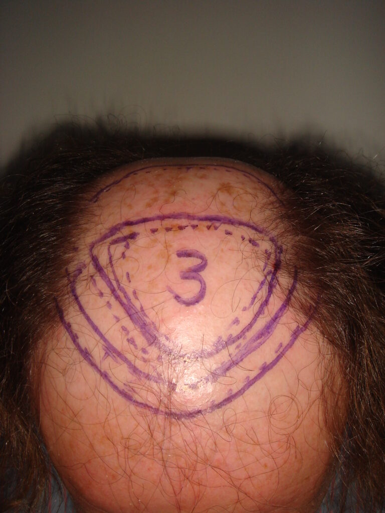 FUT 1 - before treatment