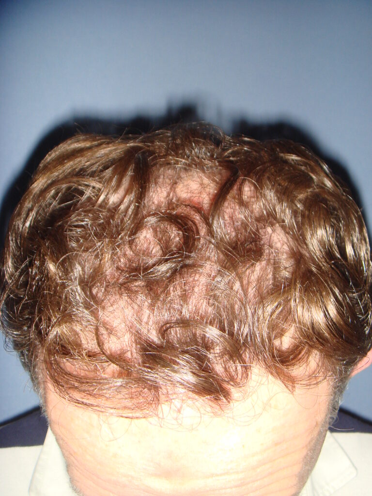 FUT 1 - after treatment