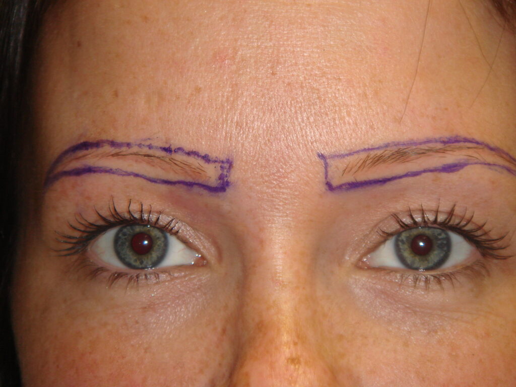 Eyebrow Transplant - before treatment
