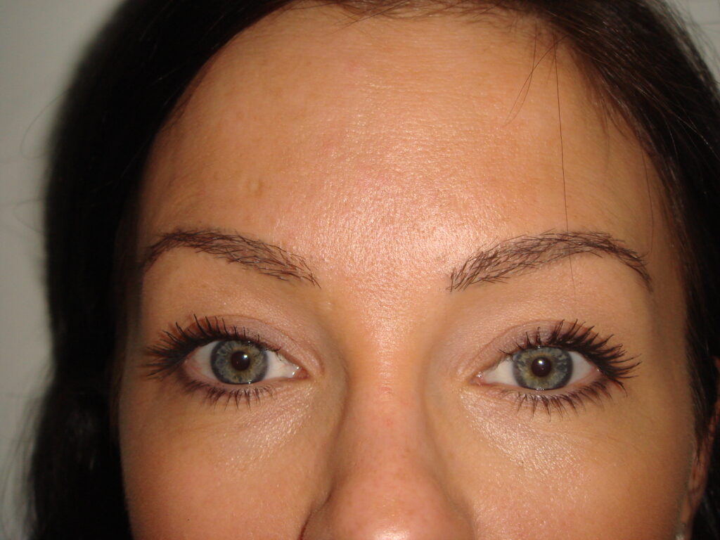 Eyebrow Transplant - after treatment