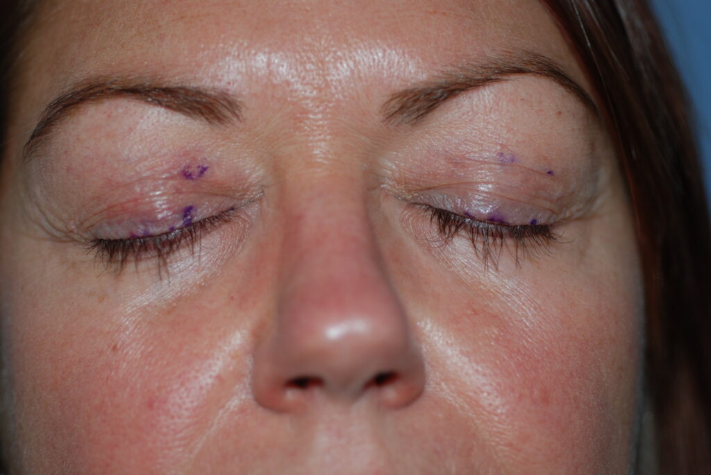 Eyelash 3 - after treatment