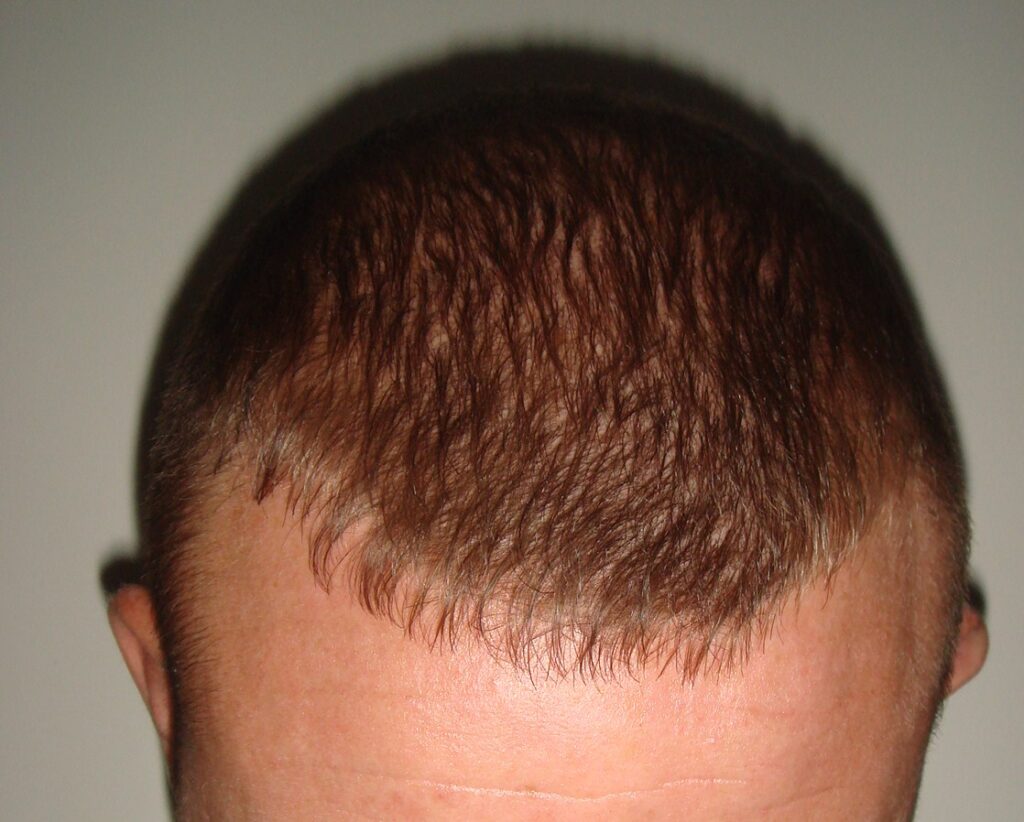 FUE 1 - after treatment