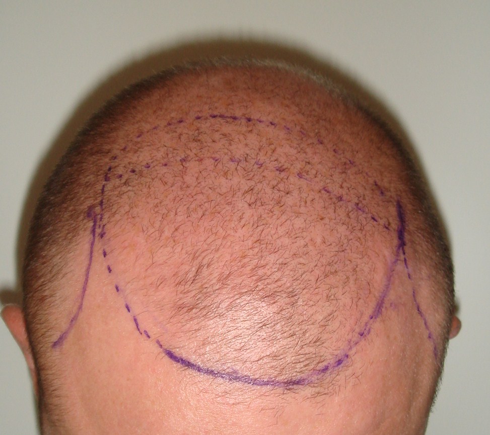 FUE 1 - before treatment