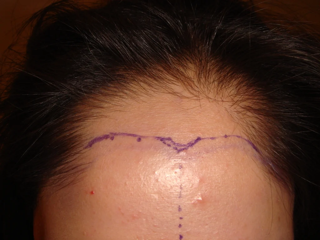 Female Hair Loss 1 - before treatment
