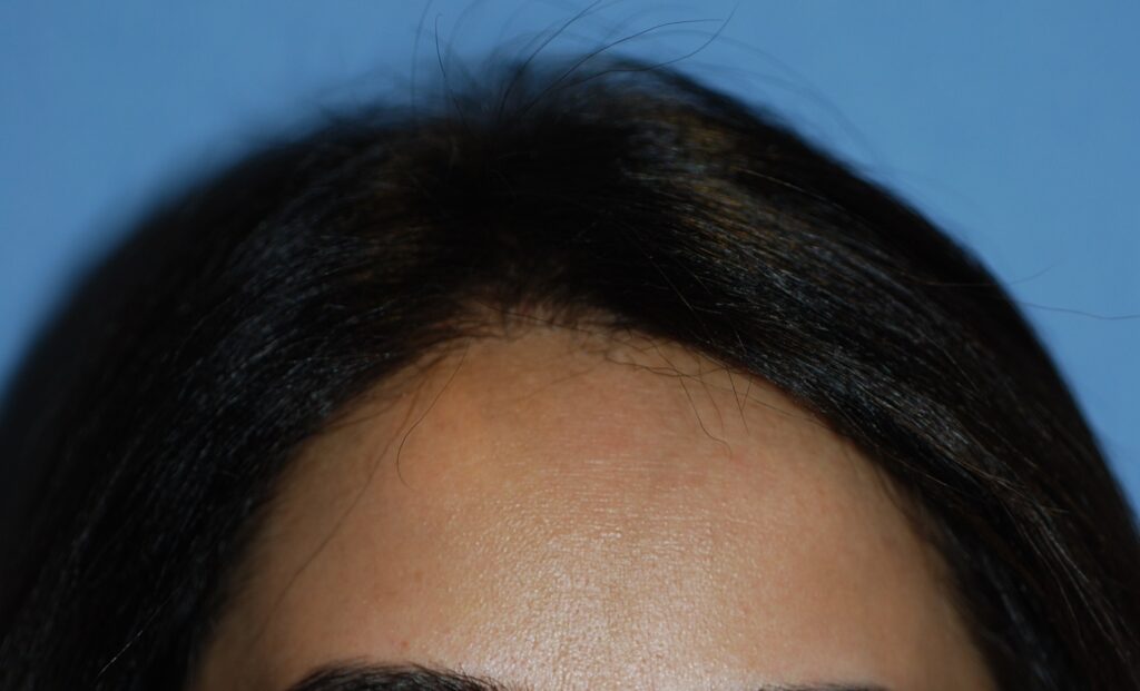 Female Hair Loss - after treatment