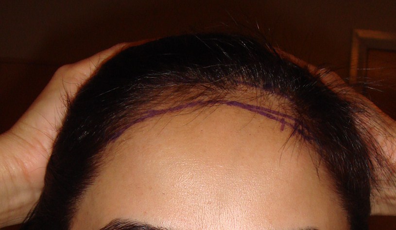 Female Hair Loss - before treatment