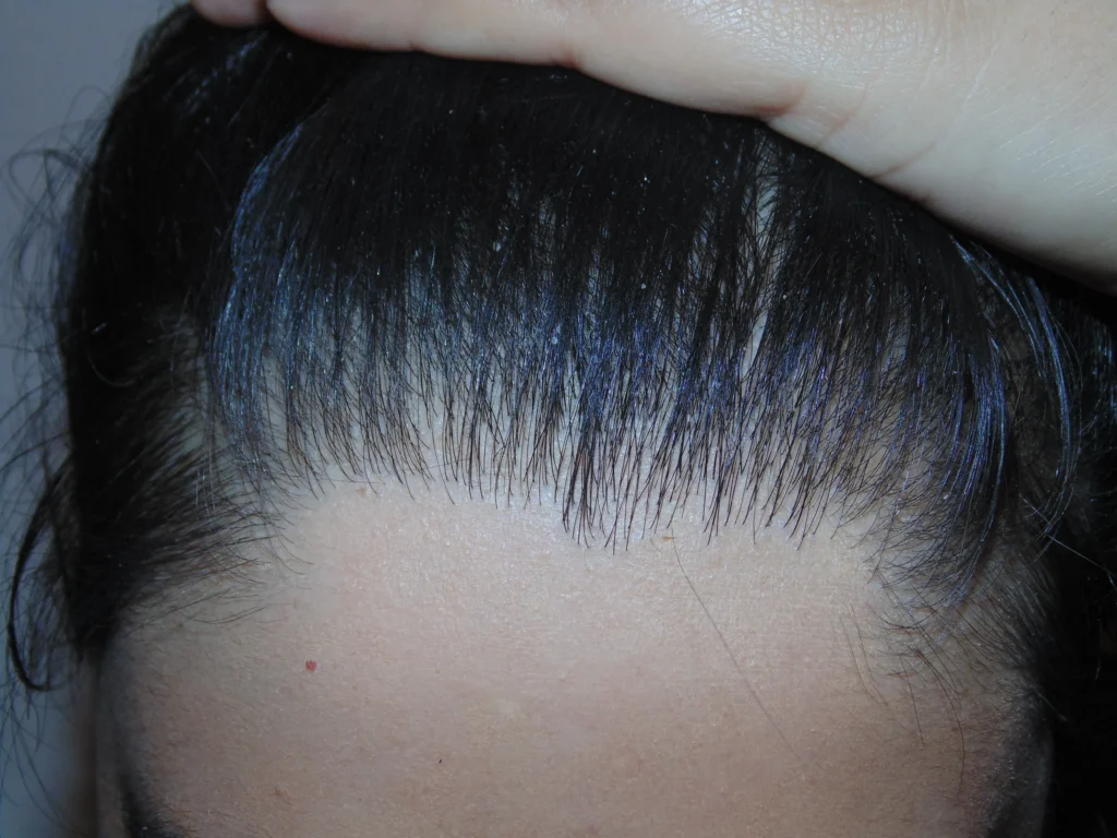 Female Hair Loss 1 - after treatment