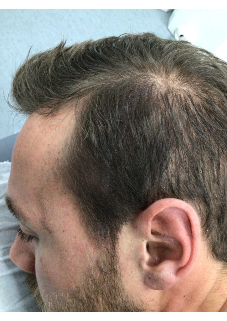Scalp Micropigmentation 2 - after treatment
