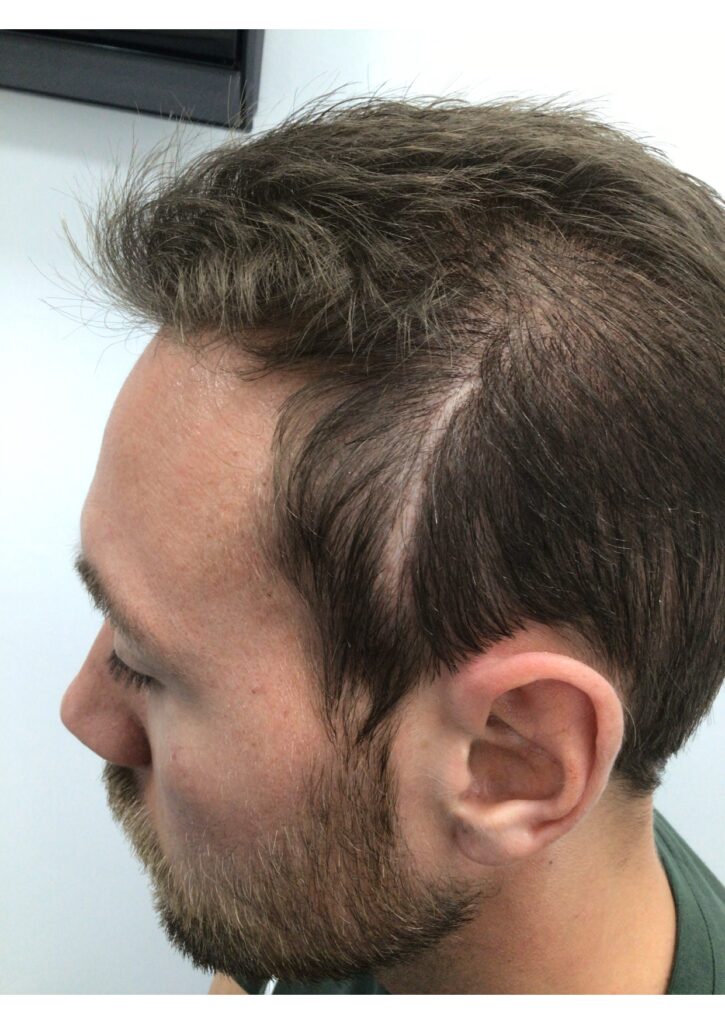 Scalp Micropigmentation 2 - before treatment