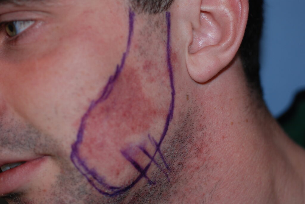 Beard Hair Transplant - before treatment