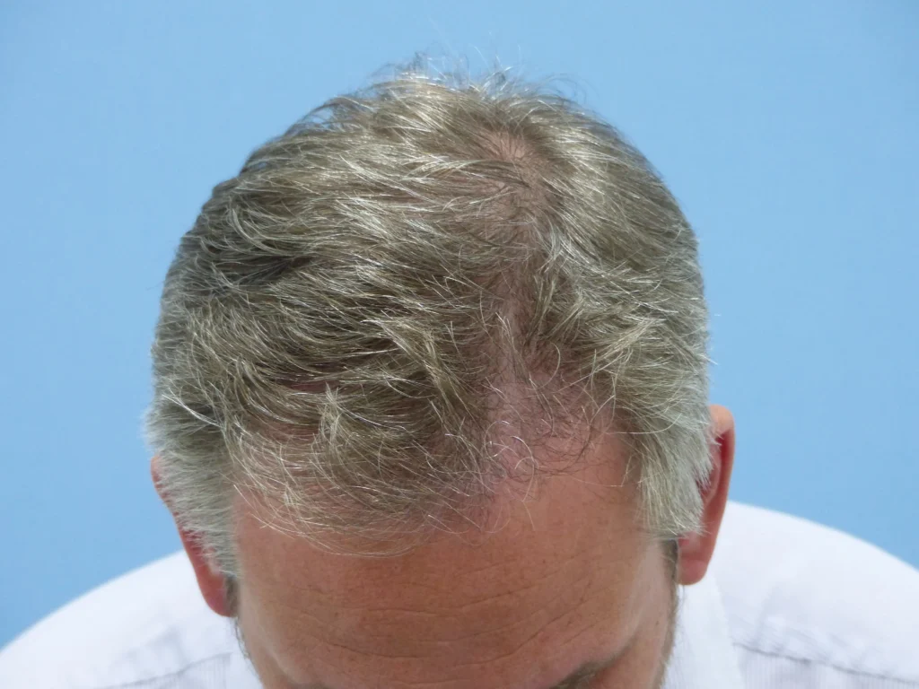 FUE 2 - after treatment