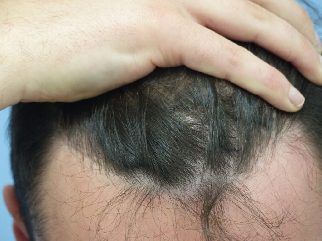 FUE - after treatment