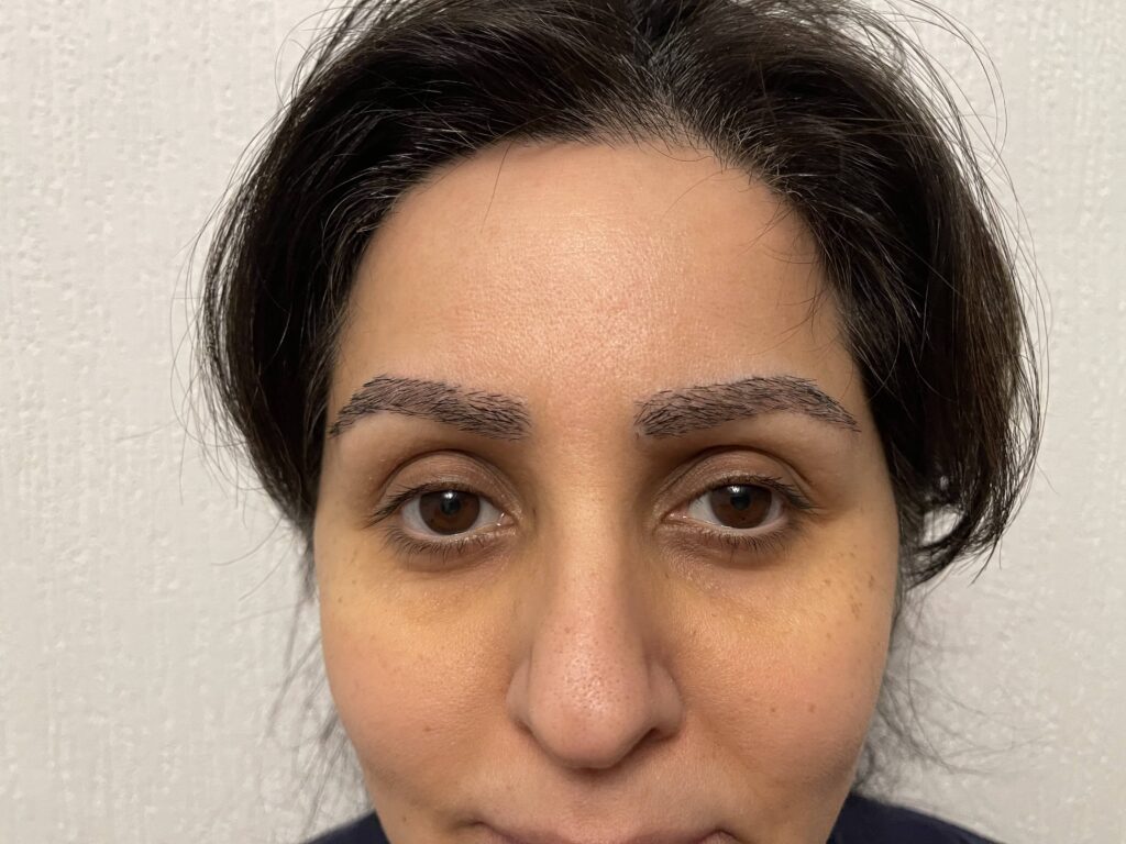 Eyebrow Transplant 2 - after treatment