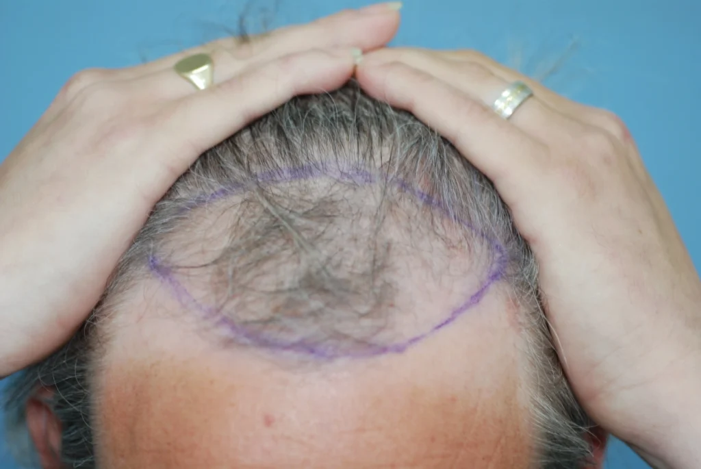FUE 2 - before treatment