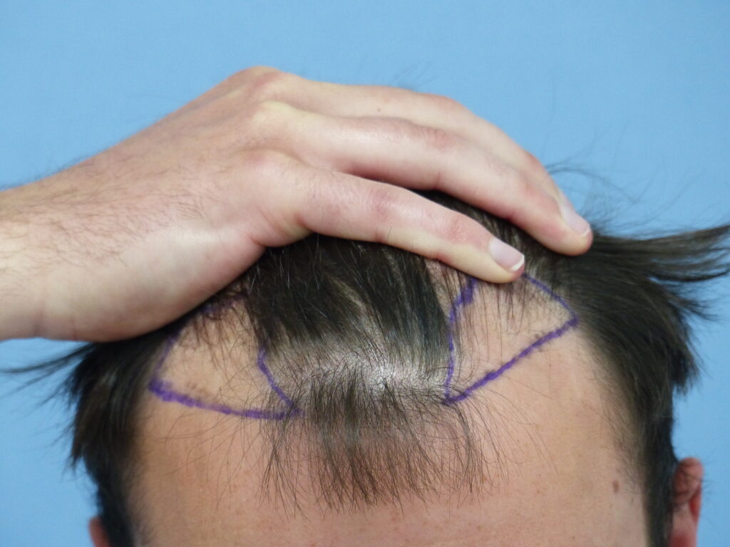FUE - before treatment