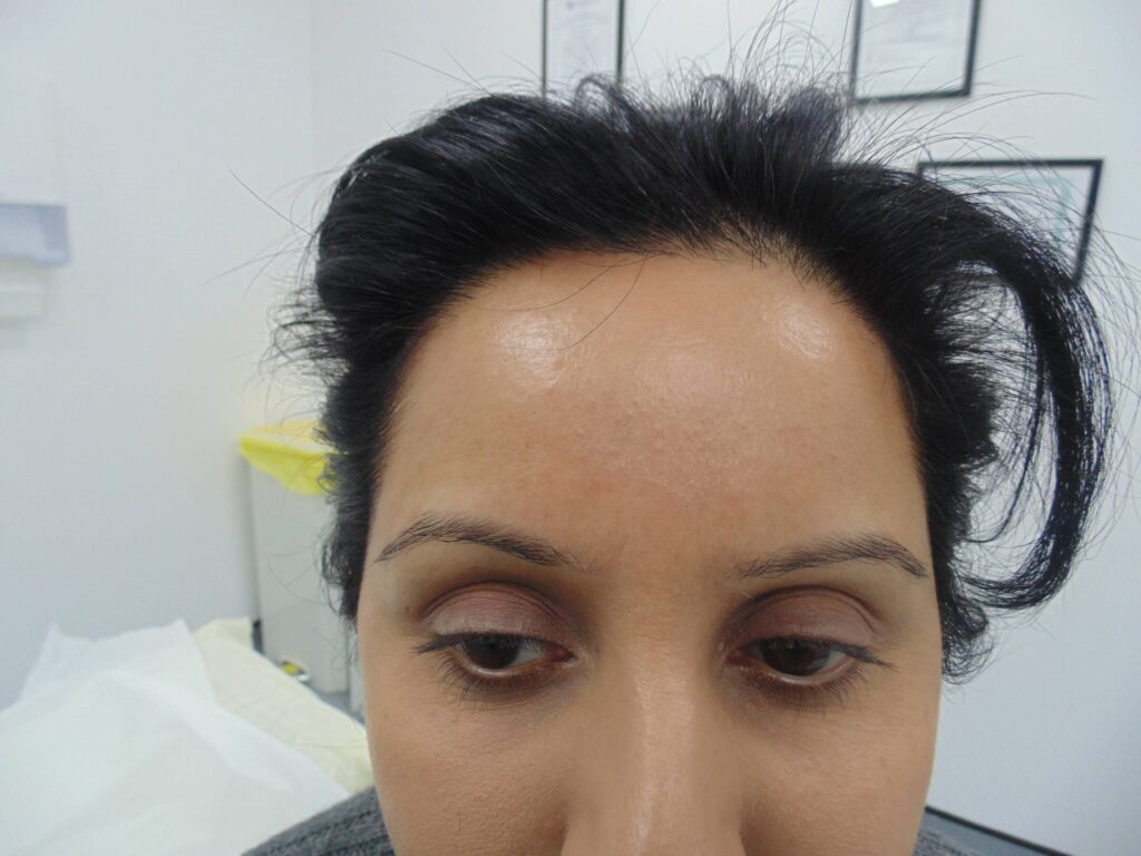 Eyebrow Transplant 2 - before treatment