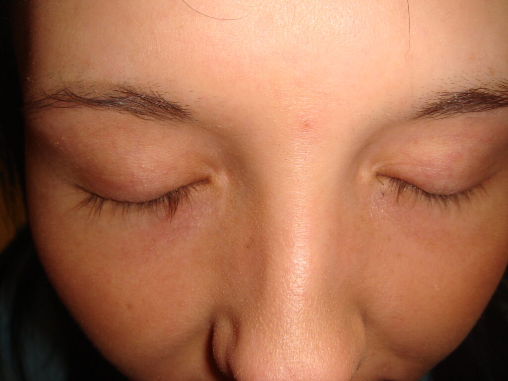 Eyelash 1 - before treatment